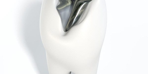 Month1_Article2 dental amalgam