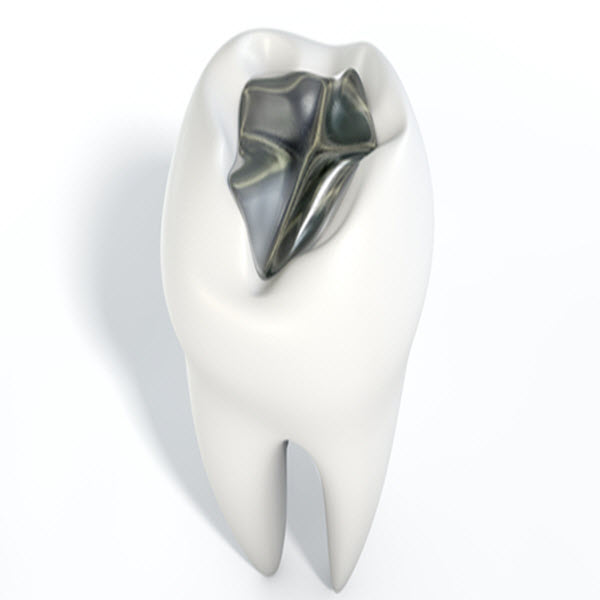 Month1_Article2 dental amalgam