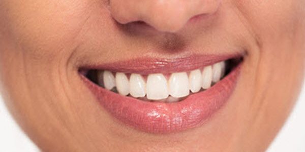 Month2_Article2 Teeth whitening