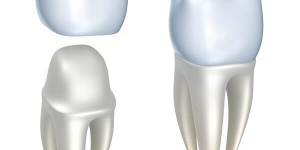 Month2_Article1 Dental Implants