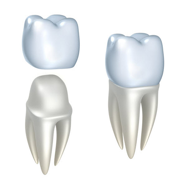 Month2_Article1 Dental Implants