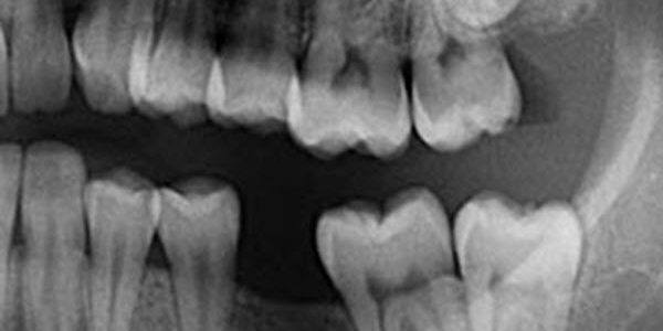 Month3_Article2 wisdom teeth