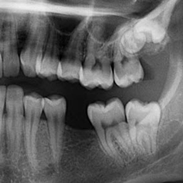 Month3_Article2 wisdom teeth