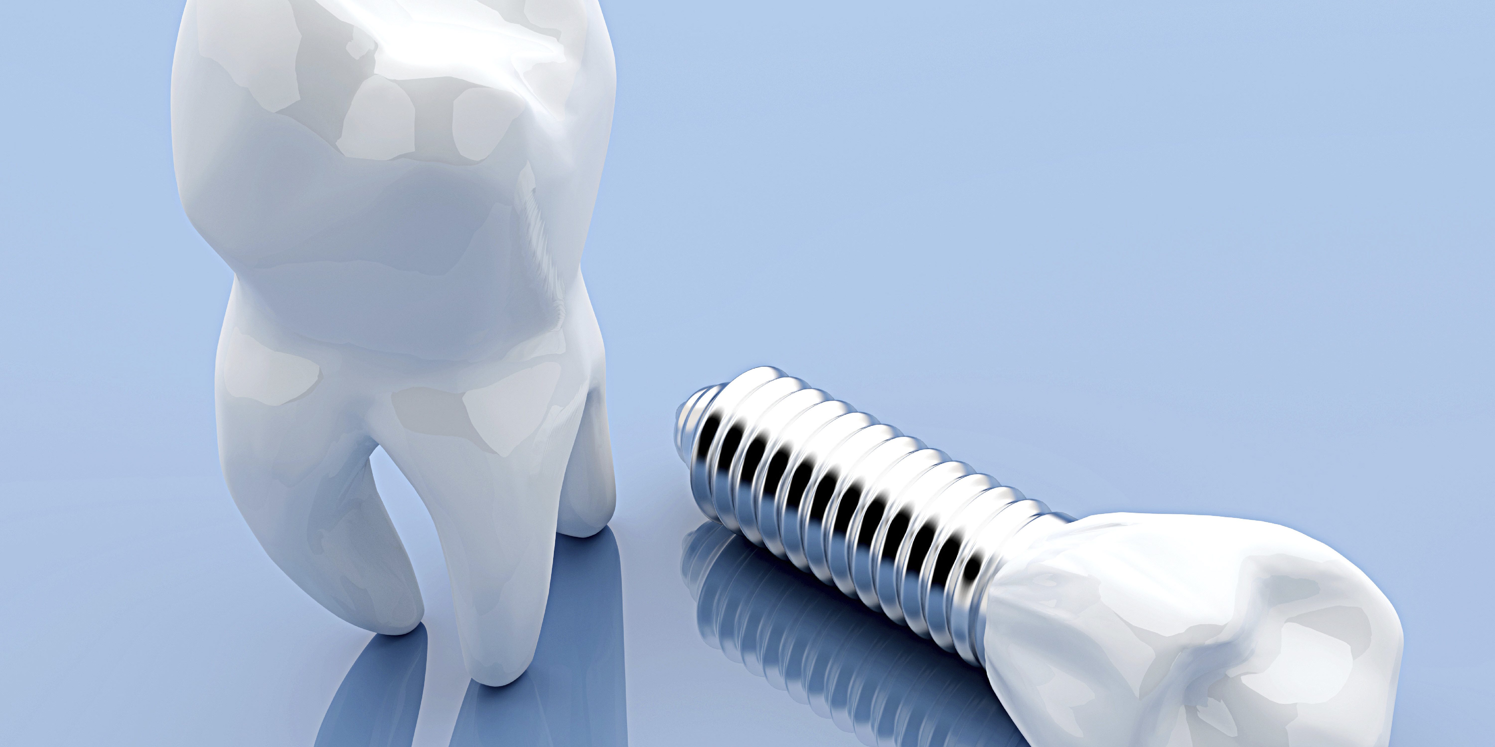 new_Month5_Article1 Dental implants
