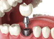 Tooth implant. Dental concept. Human teeth or dentures.
