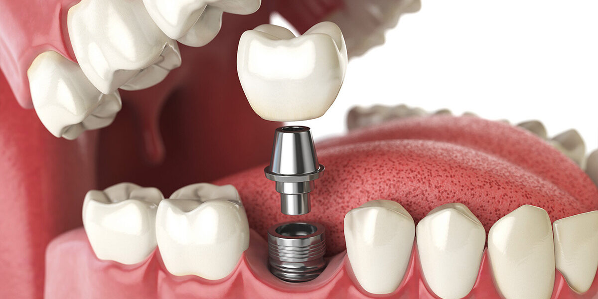 Tooth implant. Dental concept. Human teeth or dentures. Tooth implant. Dental concept. Human teeth or dentures.
