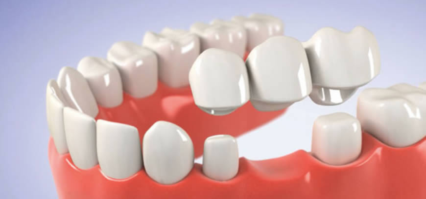 Choosing Between Dental Implants and Dental Bridges 2