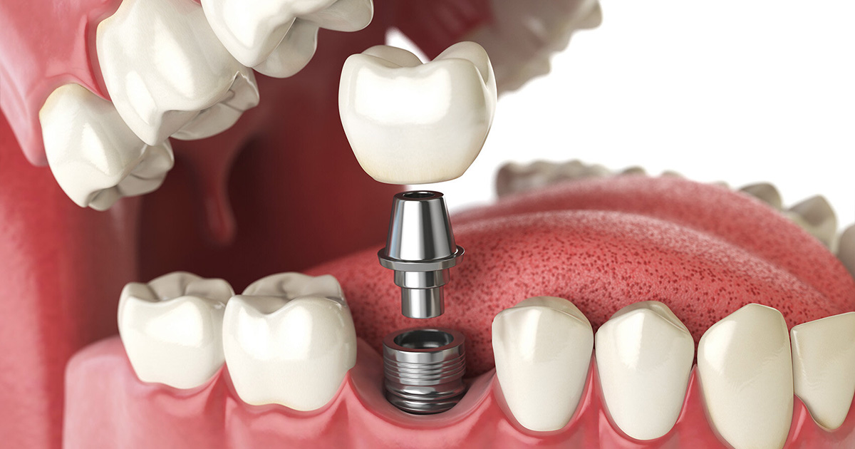 Tooth implant. Dental concept. Human teeth or dentures. Tooth implant. Dental concept. Human teeth or dentures.