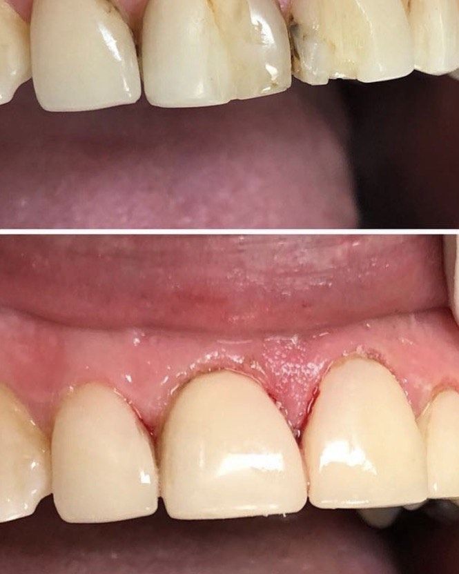 6 ways Cosmetic Dentistry and Porcelain Veneers can transform your smile 2