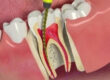 4 Most Common Dental Root Canal Treatment Myths