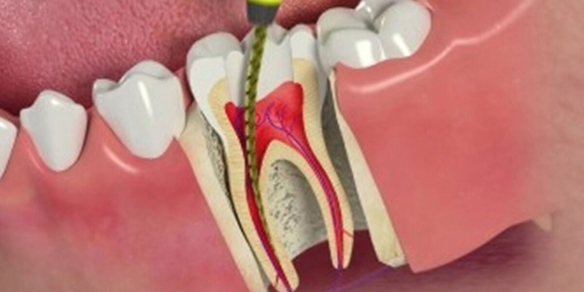 4 Most Common Dental Root Canal Treatment Myths 4 Most Common Dental Root Canal Treatment Myths