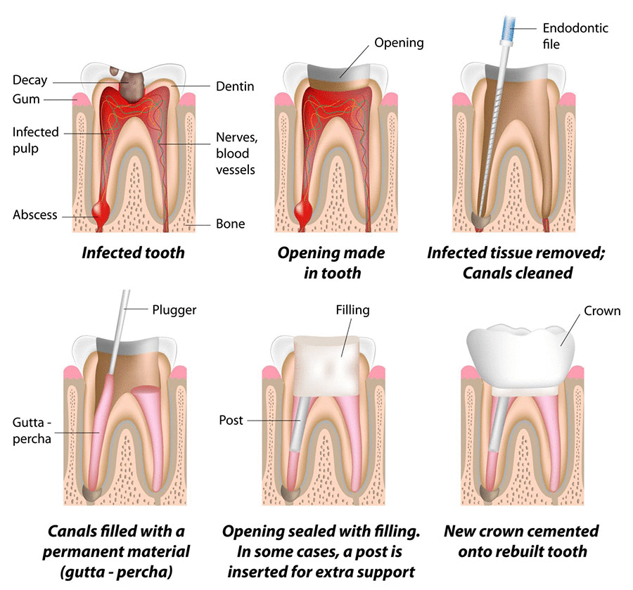 4 Most Common Dental Root Canal Treatment Myths 2