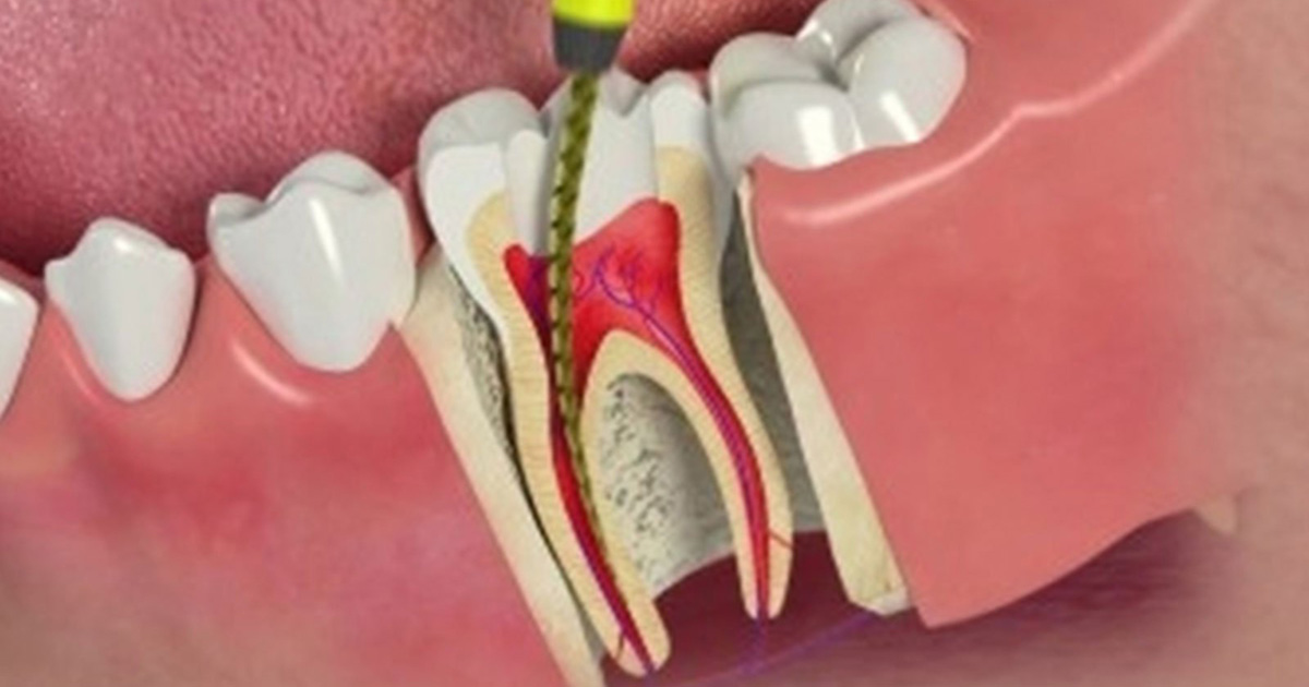 4 Most Common Dental Root Canal Treatment Myths 4 Most Common Dental Root Canal Treatment Myths