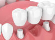 6 Things to Know Before Considering a Dental Bridge