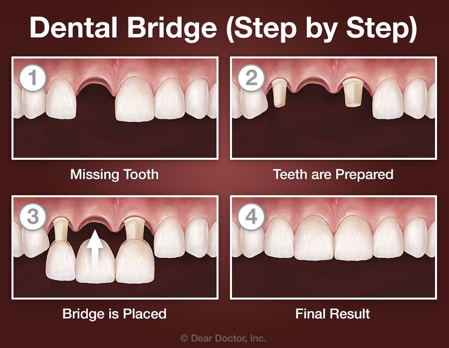 dental-bridge-placement