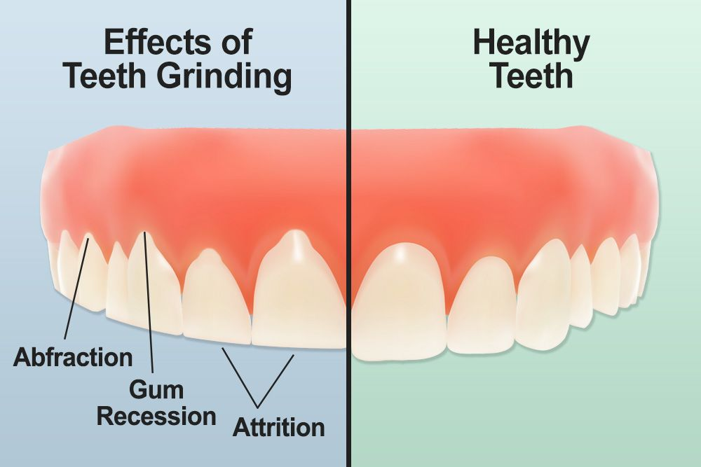 4 Imortant points about Dental Bruxism and Tooth Grinding