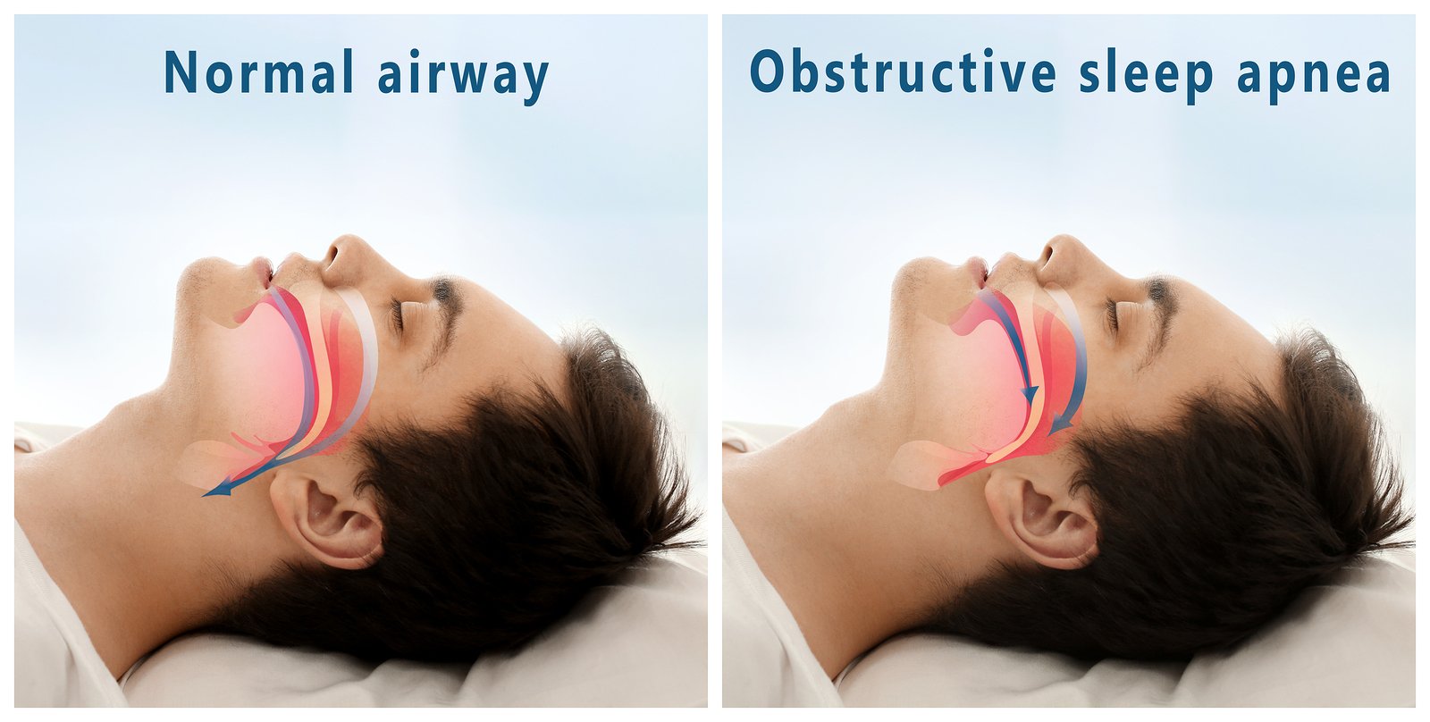 6 important points about Dental Assistance with Sleep Apnea 2
