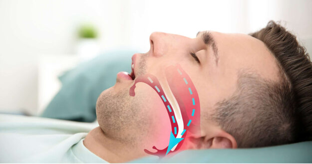 6 important points about Dental Assistance with Sleep Apnea