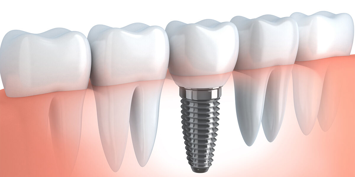 4 Fantastic Advantages Of getting Dental Implants 4 Fantastic Advantages Of getting Dental Implants