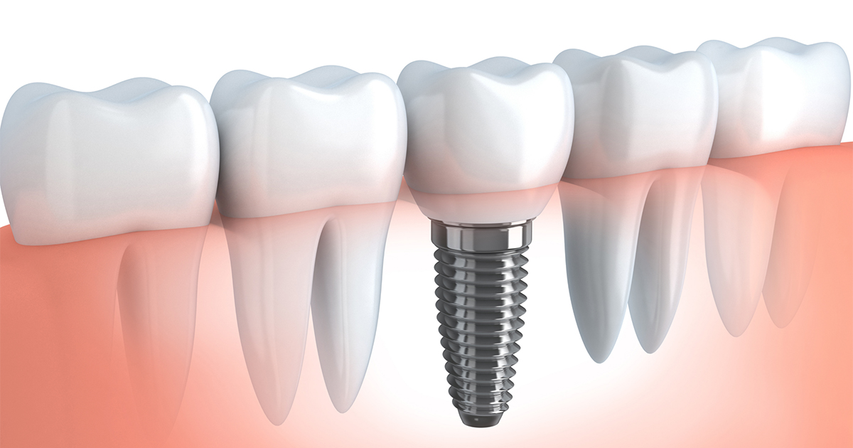 4 Fantastic Advantages Of getting Dental Implants 4 Fantastic Advantages Of getting Dental Implants
