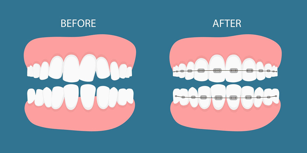 The 4 Best Cosmetic Dental Treatments For Uneven Teeth The 4 Best Cosmetic Dental Treatments For Uneven Teeth