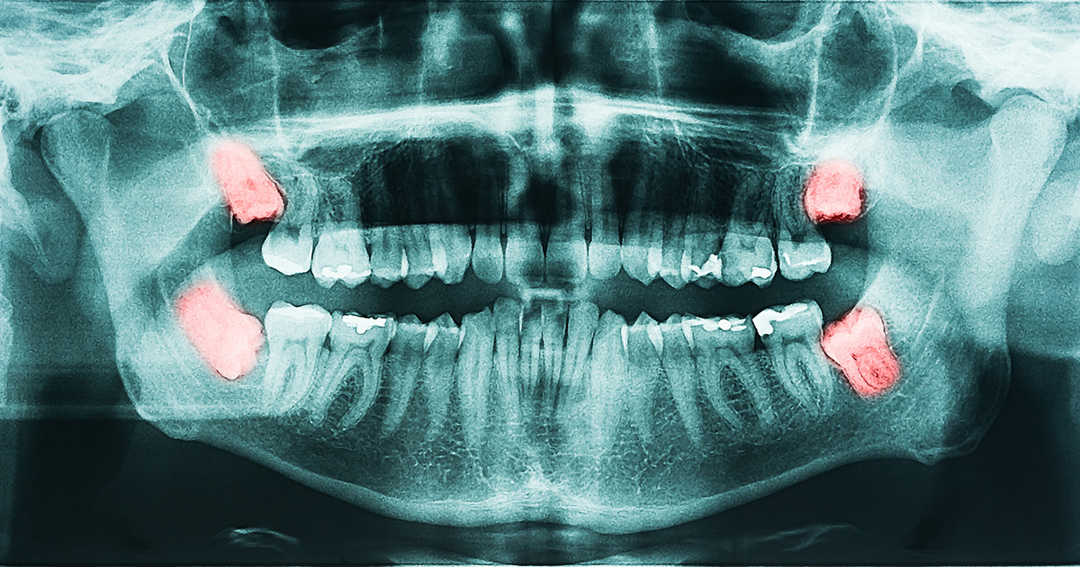 4 most important points about Wisdom Tooth Extraction 4 most important points about Wisdom Tooth Extraction