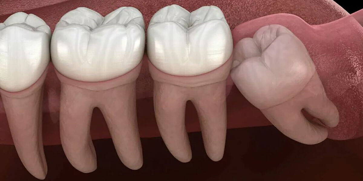 5 Things You Need to Know About Wisdom Tooth Extraction