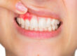 7 common symptoms of Dental Gum Disease and causes