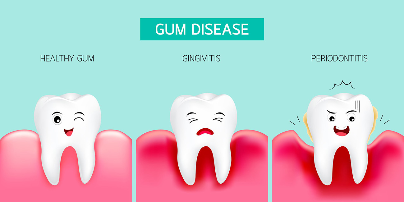 7 common symptoms of Dental Gum Disease and causes