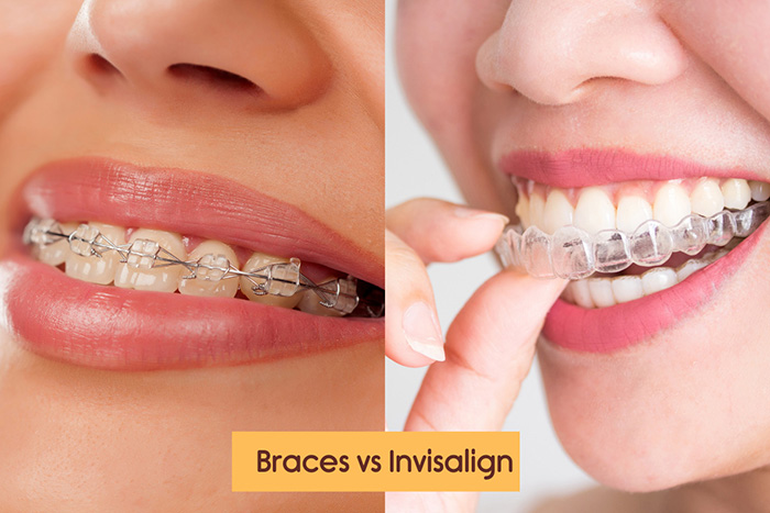 Braces vs Invisalign - Local Dental NSW