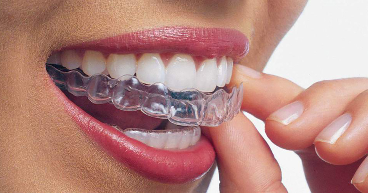 Top 4 Things To Know when considering Invisalign Top 4 Things To Know when considering Invisalign