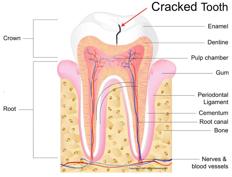 Cracked-tooth