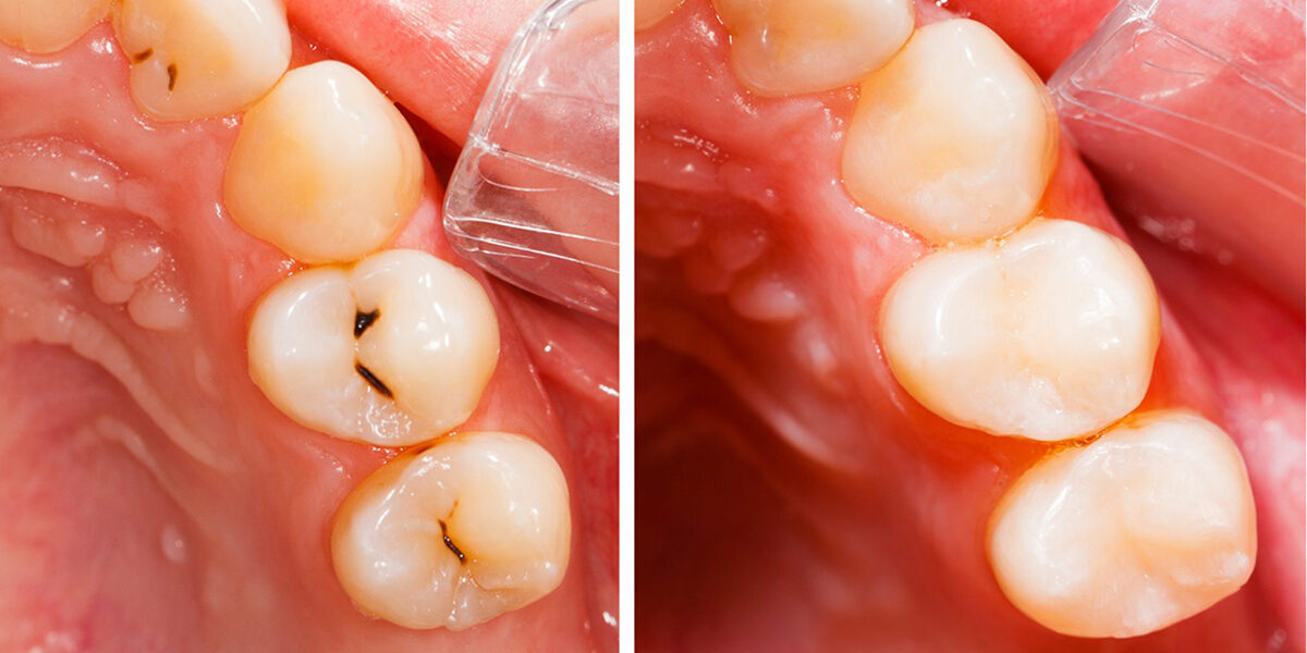 Top 4 Benefits of White Dental Fillings Top 4 Benefits of White Dental Fillings