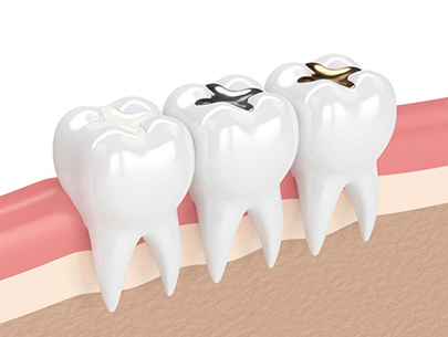 Top 4 Benefits of White Dental Fillings 2