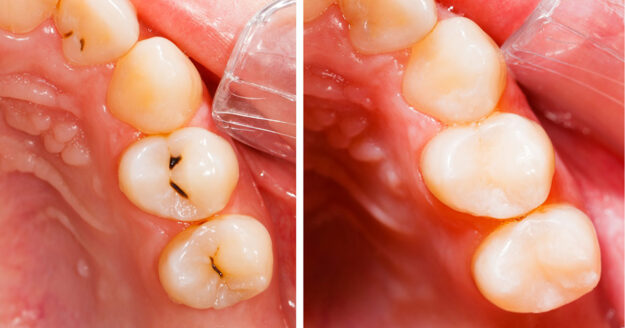 Top 4 Benefits of White Dental Fillings Top 4 Benefits of White Dental Fillings