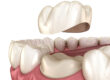 6 Important points about Dental Caps