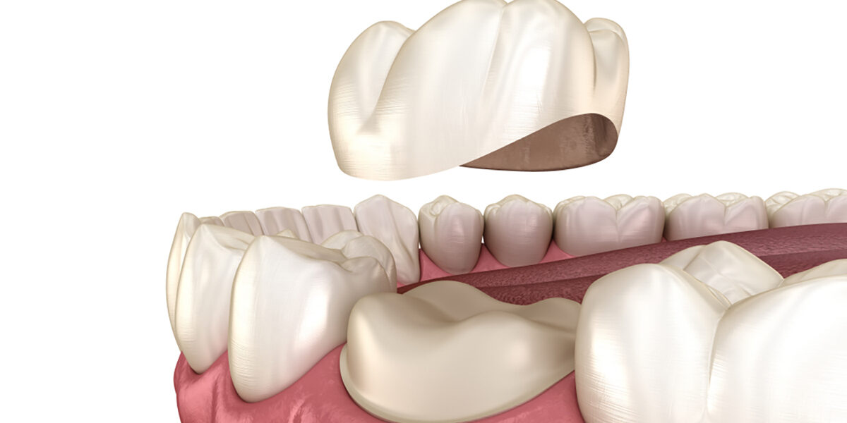 6 Important points about Dental Caps 6 Important points about Dental Caps