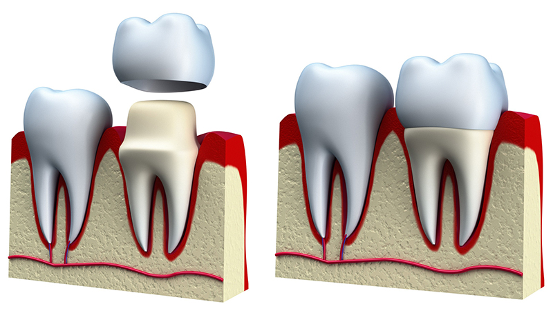 6 Important points about Dental Caps 2 sm