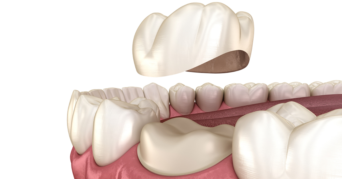 6 Important points about Dental Caps 6 Important points about Dental Caps