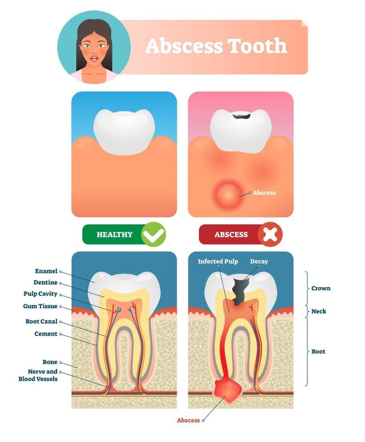 6 Important points about the Different Types of Dental Infections & treatments 2