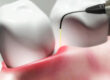 6 tips on What you Should About Dental Periodontal Pockets