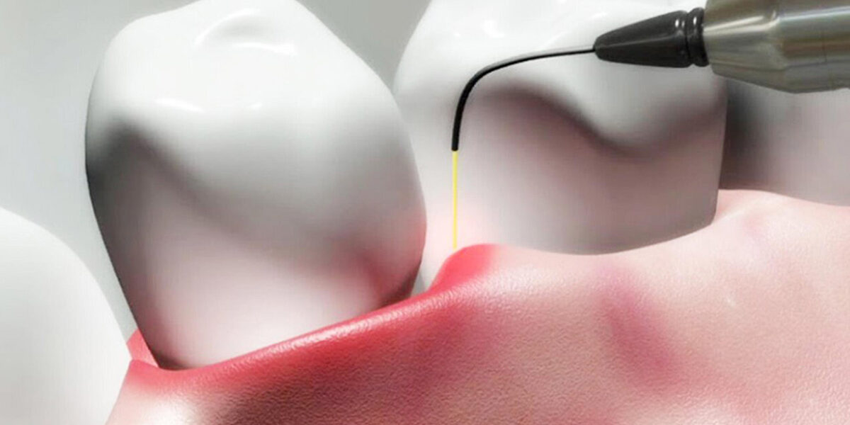 6 tips on What you Should About Dental Periodontal Pockets 6 tips on What you Should About Dental Periodontal Pockets