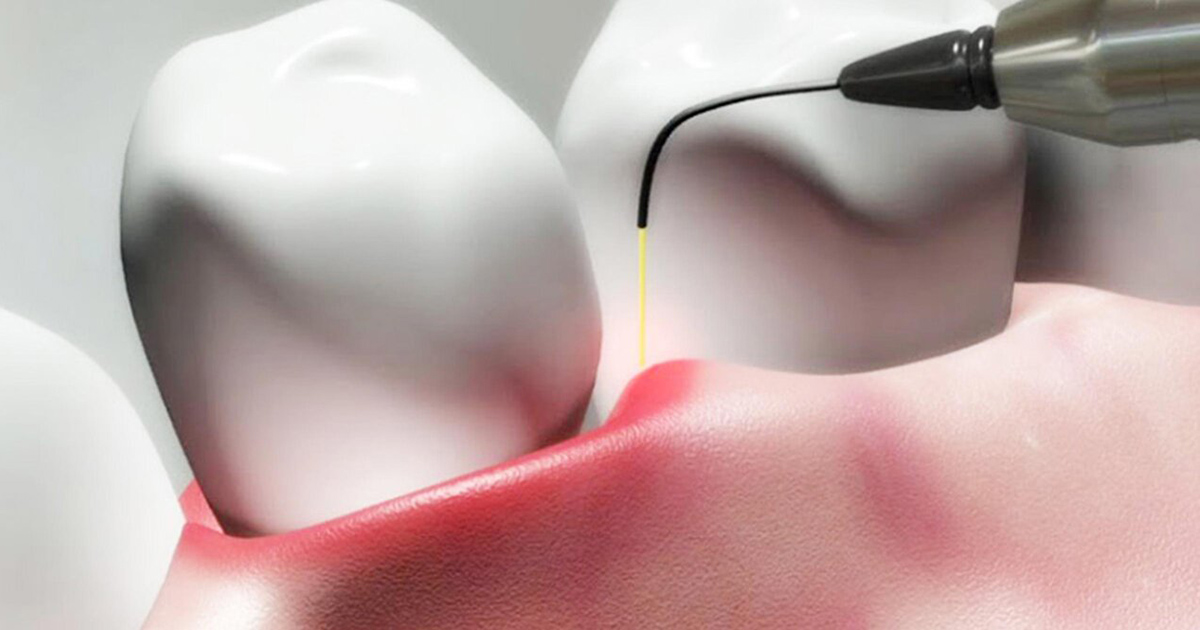 6 tips on What you Should About Dental Periodontal Pockets 6 tips on What you Should About Dental Periodontal Pockets