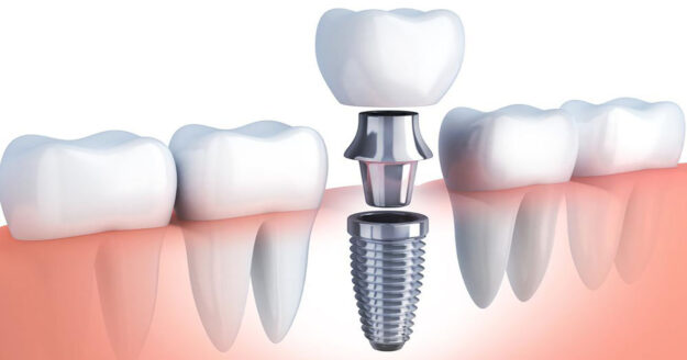 7 Reasons Why to Choose Dental Implants to Replace Teeth 1 7 Reasons Why to Choose Dental Implants to Replace Teeth 1