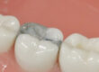 Amalgam Fillings The Truth About How Safe They Are 2