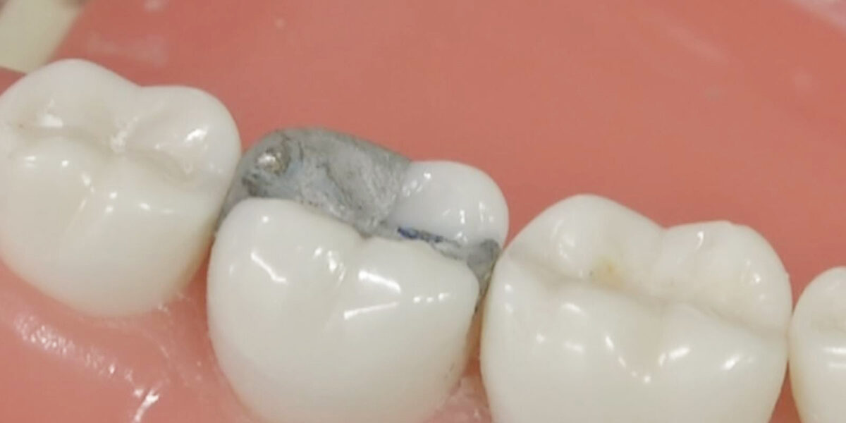 Amalgam Fillings The Truth About How Safe They Are 2 Amalgam Fillings The Truth About How Safe They Are 2