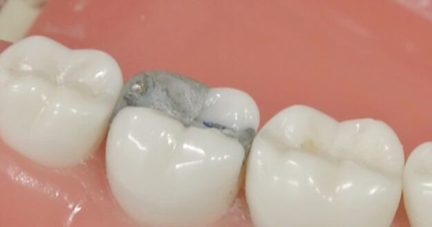 Amalgam Fillings The Truth About How Safe They Are 2 Amalgam Fillings The Truth About How Safe They Are 2