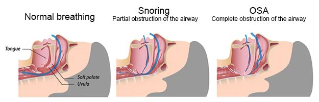 Are Oral Appliances Good For Sleep Apnea 3