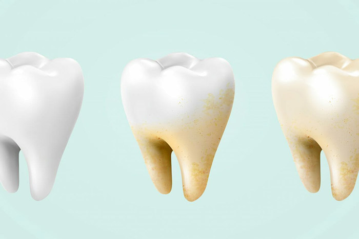 3 points for Causes and Treatment For Yellow Teeth 2 copy 3 points for Causes and Treatment For Yellow Teeth 2 copy
