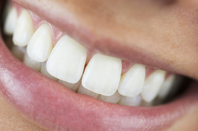 Is There Any Treatment For Underbite?